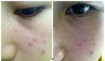 明星网红用的痘痘贴,明星同款痘痘贴，轻松遮瑕美肌秘籍